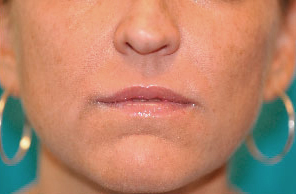Dermal Filler Before and After Photos Case 4027 After Photo Dermal Filler Before and After Photos