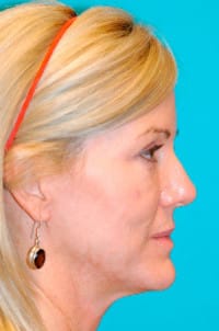 Dermal Filler Before and After Photos