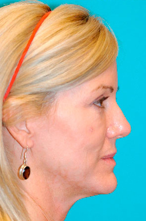 Dermal Filler Before and After Photos