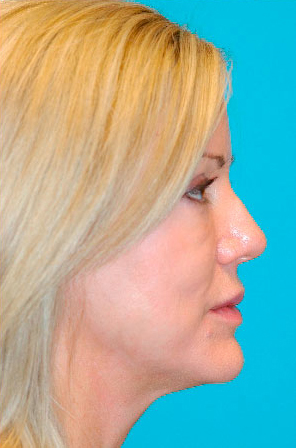 Dermal Filler Before and After Photos