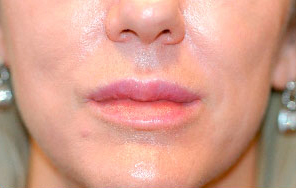 Dermal Filler