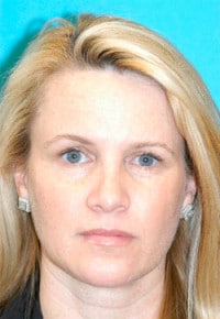 Dermal Filler Before and After Photos