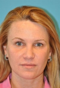 Dermal Filler Before and After Photos