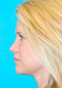 Dermal Filler Before and After Photos