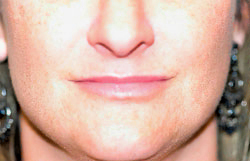 Dermal Filler Before and After Photos