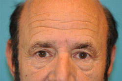 Lower Blepharoplasty (Eyelid) Before and After Photos