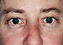 Lower Blepharoplasty (Eyelid) Before and After Photos Case 3467 Before Photo Lower Blepharoplasty (Eyelid) Before and After Photos