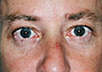 Lower Blepharoplasty (Eyelid) Before and After Photos