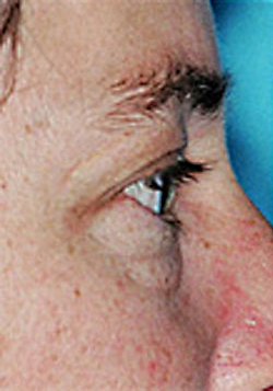 Lower Blepharoplasty (Eyelid) Before and After Photos Case 3467 Before Photo Lower Blepharoplasty (Eyelid) Before and After Photos