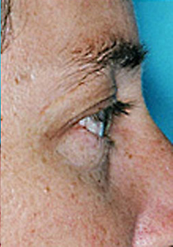 Lower Blepharoplasty (Eyelid) Before and After Photos Case 3467 After Photo Lower Blepharoplasty (Eyelid) Before and After Photos