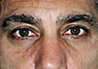 Lower Blepharoplasty (Eyelid) Before and After Photos