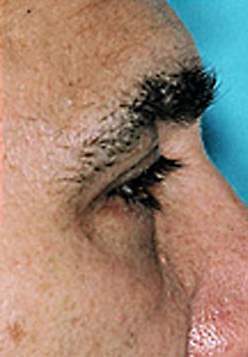 Lower Blepharoplasty (Eyelid) Before and After Photos