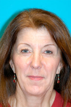 Medical Grade Skin Care Before and After Photos Case 3994 After Photo Medical Grade Skin Care Before and After Photos