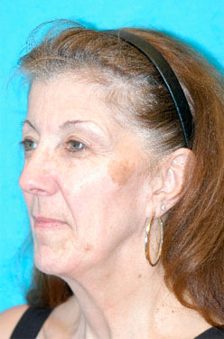 Medical Grade Skin Care Before and After Photos Case 3994 Before Photo Medical Grade Skin Care Before and After Photos