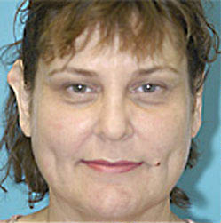 Otoplasty (Ear Reduction) Before and After Photos Case 3514 Before Photo Otoplasty (Ear Reduction) Before and After Photos