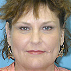 Otoplasty (Ear Reduction) Before and After Photos Case 3514 After Photo Otoplasty (Ear Reduction) Before and After Photos