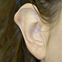 Otoplasty (Ear Reduction)