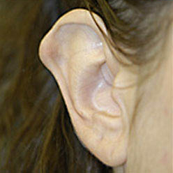 Otoplasty (Ear Reduction) Before and After Photos Case 3514 Before Photo Otoplasty (Ear Reduction) Before and After Photos