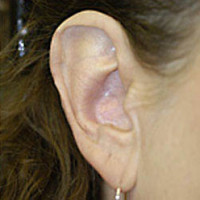 Otoplasty (Ear Reduction)