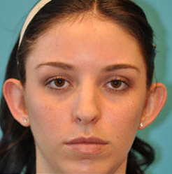 Otoplasty (Ear Reduction) Case 3664 Before Photo Otoplasty (Ear Reduction)