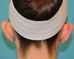 Otoplasty (Ear Reduction) Case 3664 Before Photo Otoplasty (Ear Reduction)