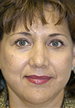 Revision Rhinoplasty Before and After Photos Case 3453 After Photo Revision Rhinoplasty Before and After Photos