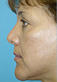 Revision Rhinoplasty Before and After Photos