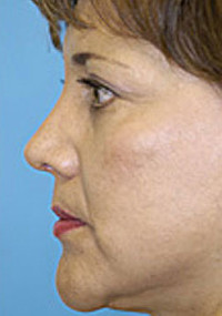 Revision Rhinoplasty Before and After Photos