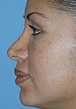 Revision Rhinoplasty Before and After Photos Case 3485 Before Photo Revision Rhinoplasty Before and After Photos
