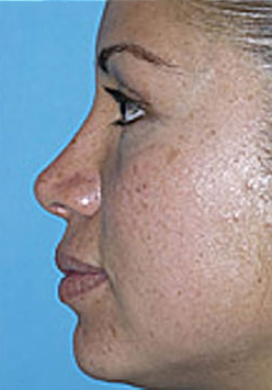 Revision Rhinoplasty Before and After Photos