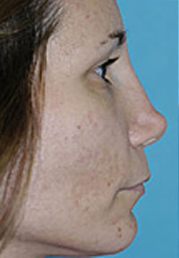 Revision Rhinoplasty Before and After Photos