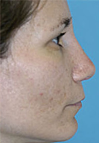 Revision Rhinoplasty Before and After Photos