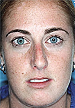 Revision Rhinoplasty Before and After Photos Case 3597 Before Photo Revision Rhinoplasty Before and After Photos