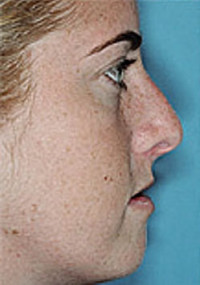 Revision Rhinoplasty Before and After Photos