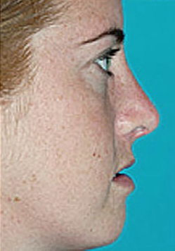 Revision Rhinoplasty Before and After Photos Case 3597 After Photo Revision Rhinoplasty Before and After Photos
