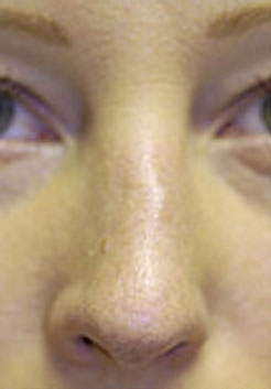 Revision Rhinoplasty Before and After Photos Case 3655 Before Photo Revision Rhinoplasty Before and After Photos