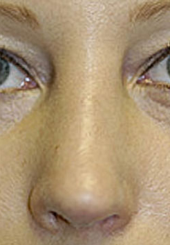 Revision Rhinoplasty Before and After Photos Case 3655 After Photo Revision Rhinoplasty Before and After Photos