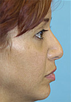 Revision Rhinoplasty Before and After Photos