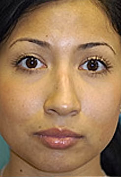 Revision Rhinoplasty Before and After Photos Case 3815 Before Photo Revision Rhinoplasty Before and After Photos