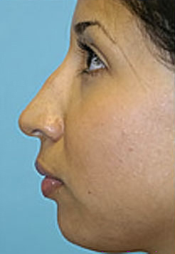 Revision Rhinoplasty Before and After Photos Case 3815 Before Photo Revision Rhinoplasty Before and After Photos
