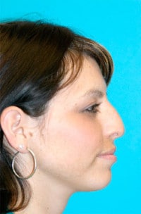 Rhinoplasty (Nose Job) Before and After Photos