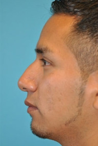 Rhinoplasty (Nose Job) Before and After Photos