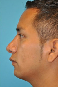 Rhinoplasty (Nose Job) Before and After Photos