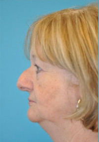 Rhinoplasty (Nose Job)