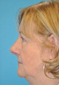 Rhinoplasty (Nose Job)