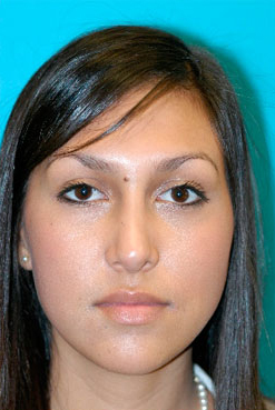 Rhinoplasty (Nose Job) Before and After Photos Case 3537 After Photo Rhinoplasty (Nose Job) Before and After Photos