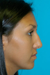 Rhinoplasty (Nose Job)