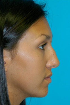 Rhinoplasty (Nose Job) Before and After Photos Case 3537 Before Photo Rhinoplasty (Nose Job) Before and After Photos