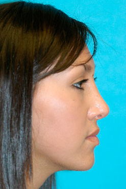 Rhinoplasty (Nose Job) Before and After Photos Case 3537 After Photo Rhinoplasty (Nose Job) Before and After Photos
