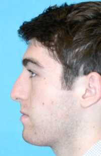 Rhinoplasty (Nose Job) Before and After Photos